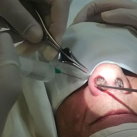 Гигантскую опухоль удалили нижегородские врачи из носа пациента - фото 1