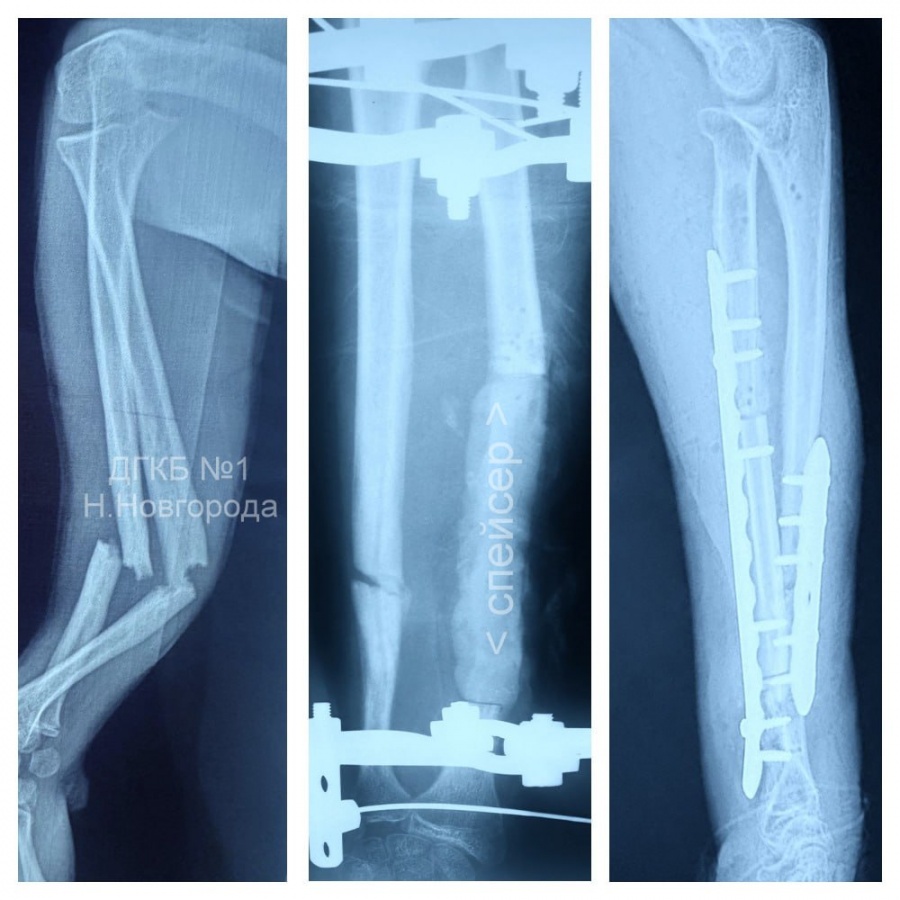 Нижегородские врачи спасли подростка с гнойным воспалением костей руки - фото 1